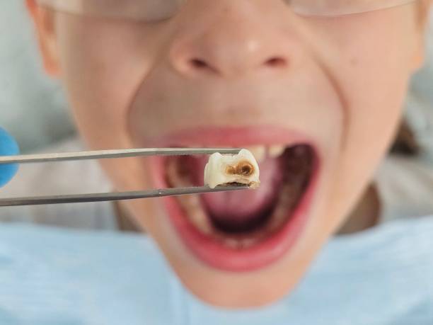 Best Emergency Dental Care for Broken or Chipped Teeth in Lithia Springs, GA